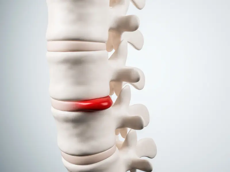 Disc Injury Treatment Near Me in Citrus Heights, CA. Chiropractor For Disc Injury Pain Relief.